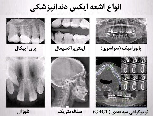 انواع رادیوگرافی خارج دهانی